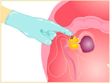 Cáncer-de-Próstata tacto rectal