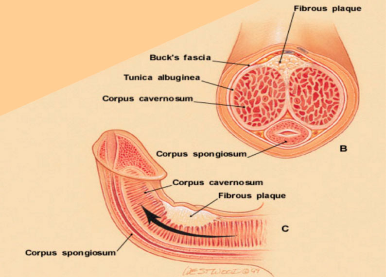 Extensor peneal para curvatura del pene enfermedad Peyronie