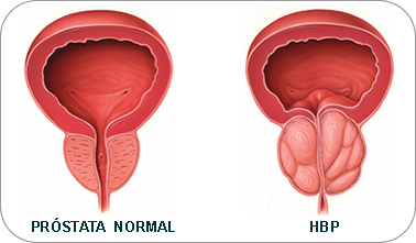 prostata tumor benigno