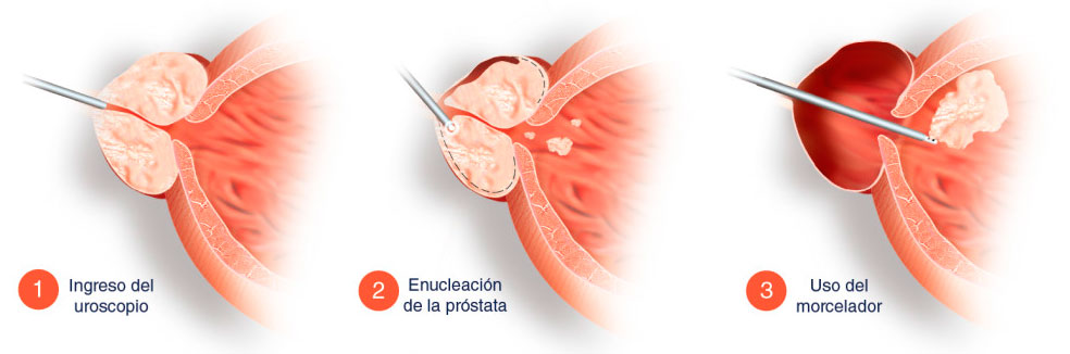 Hiperplasia-Benigna-de-próstata