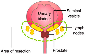 cancer-de-porstata Prostatectomía radical