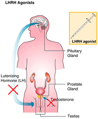 cancer-de-próstata-tratatamiento-hormonal