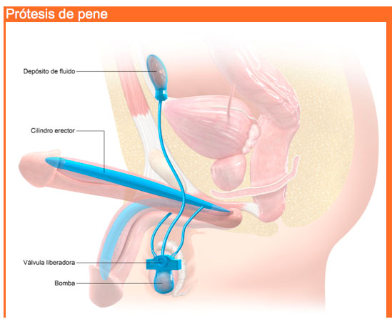 Disfunción-Erectil y tratamiento con prótesis de pene