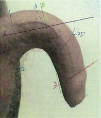 curvatura congenita del pene