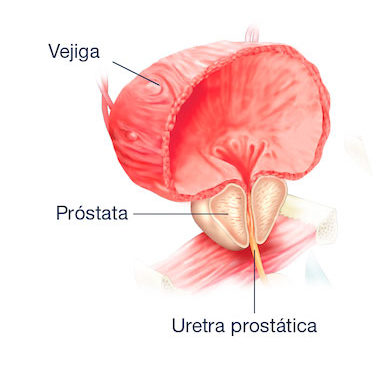 Avances en hiperplasia de próstata