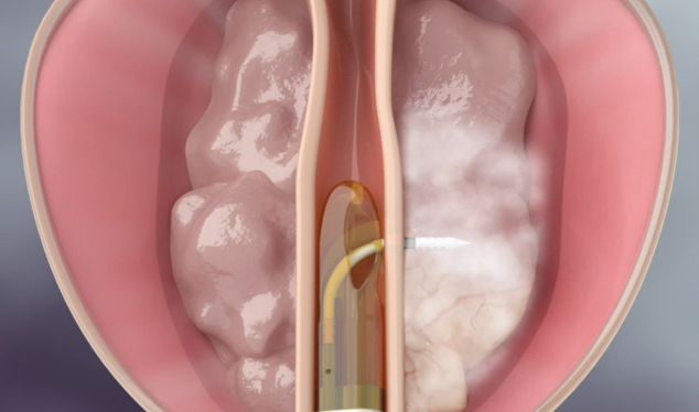 Vídeo Terapia térmica con vapor de agua para hiperplasia benigna de próstata - REZUM