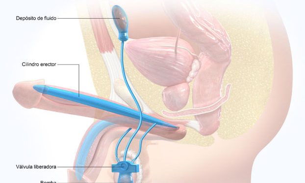 Prótesis de pene: la solución definitiva