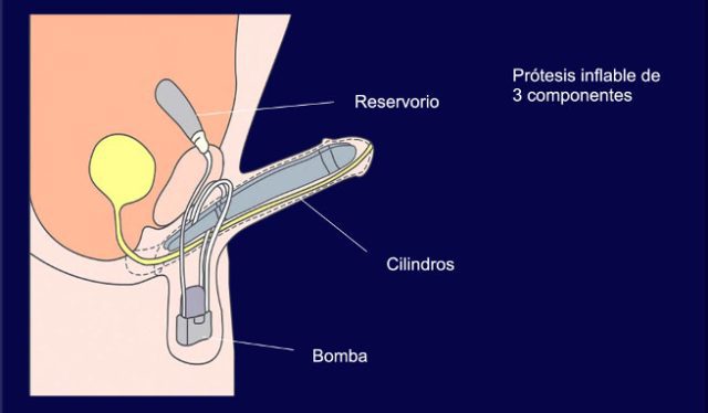 Prótesis del pene - La solución definitiva (3)