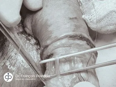 Neurectomía dorsal selectiva Dr. Peinado