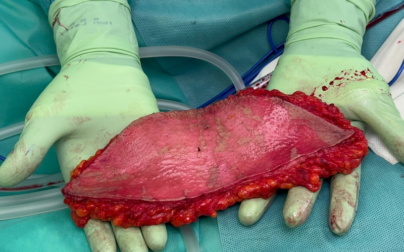 Doctor Peinado realizando abdominoplastia inferior (dermis y grasa subdérmica) para creación de injerto dermograso
