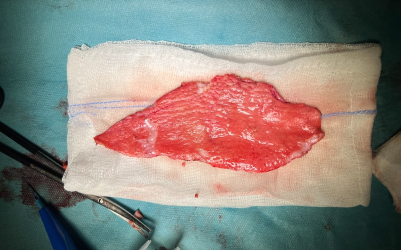 Injerto dermograso creado por el Doctor Peinado, una vez retirada la epidermis.