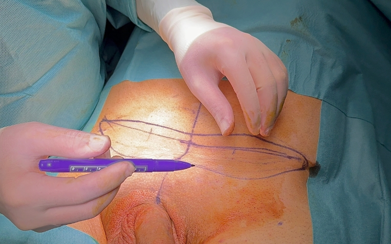 Doctor Peinado marcando zona de resección en el abdomen del paciente, para creación de injerto dermograso