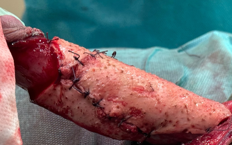 Injerto dermograso colocado alrededor del pene