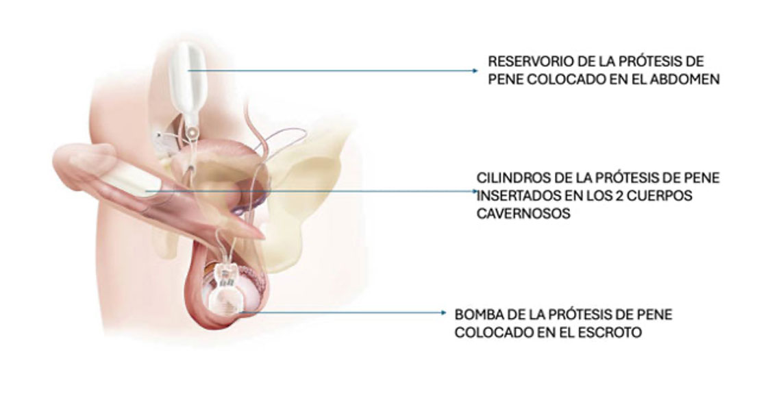 Prótesis pene 3 piezas