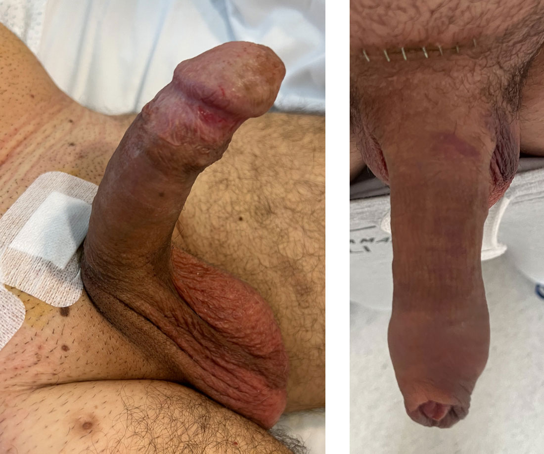 Pene con prótesis recién operado
